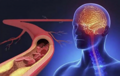 Склероз сосудов головного мозга: симптомы, лечение 